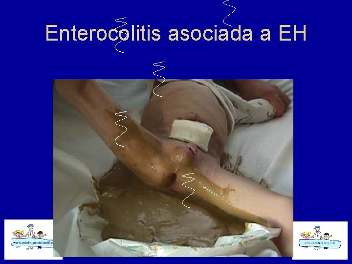 Enterocolitis asociada a EH 