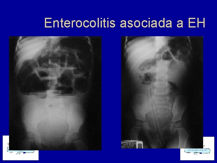 Enterocolitis asociada a EH 