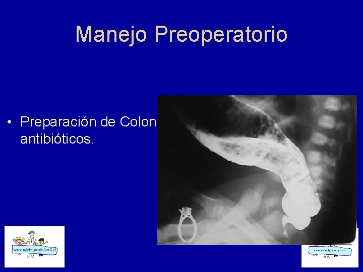Manejo Preoperatorio • Preparación de Colon, antibióticos. 