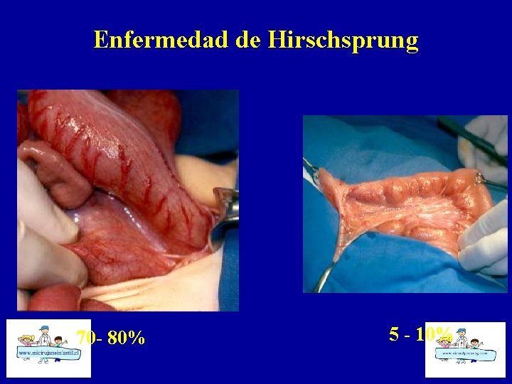 Enfermedad de Hirschsprung 70 - 80% 5 - 10% 