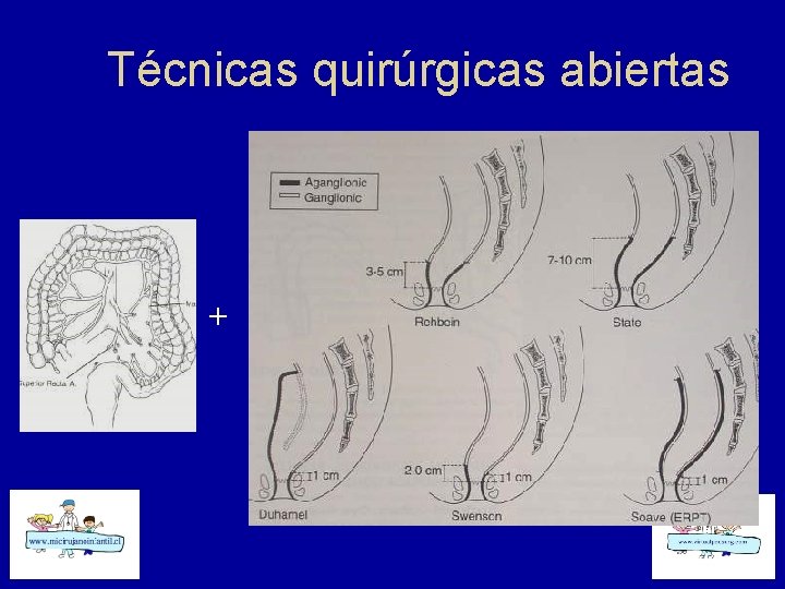 Técnicas quirúrgicas abiertas + 