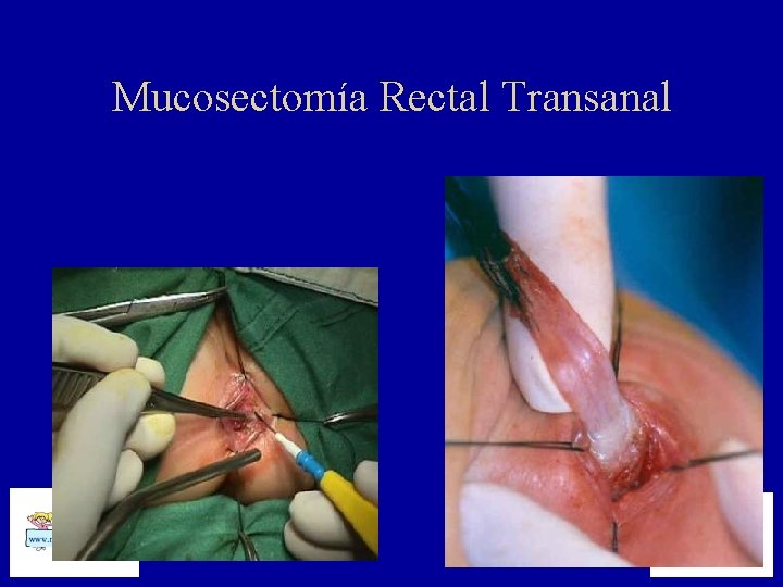 Mucosectomía Rectal Transanal 