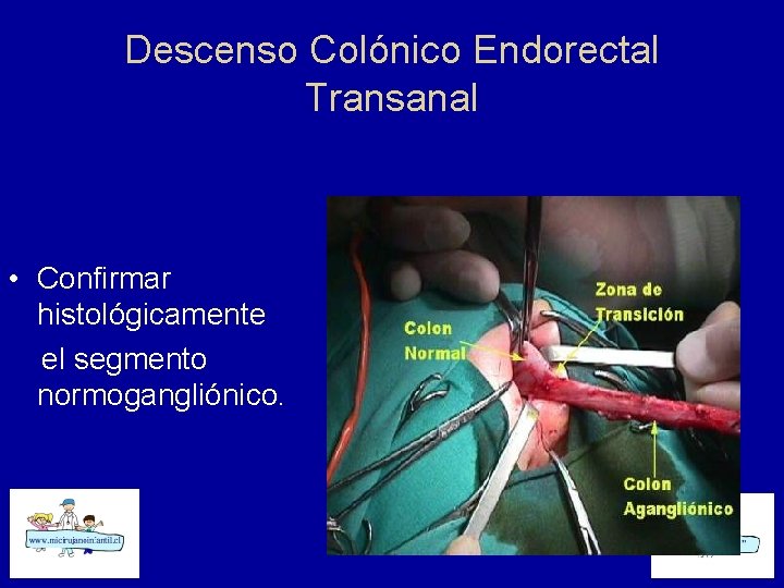 Descenso Colónico Endorectal Transanal • Confirmar histológicamente el segmento normogangliónico. 