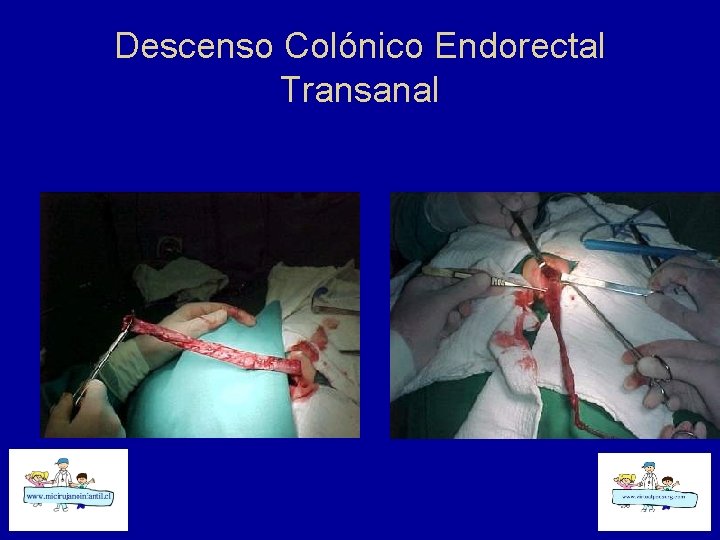 Descenso Colónico Endorectal Transanal 