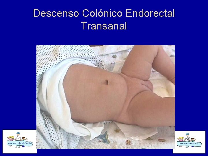 Descenso Colónico Endorectal Transanal 