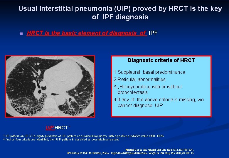 Usual interstitial pneumonia (UIP) proved by HRCT is the key of IPF diagnosis n