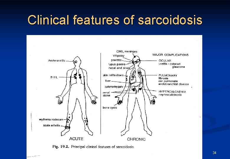 Clinical features of sarcoidosis 34 