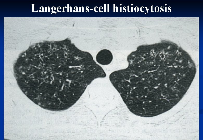 Langerhans-cell histiocytosis 44 