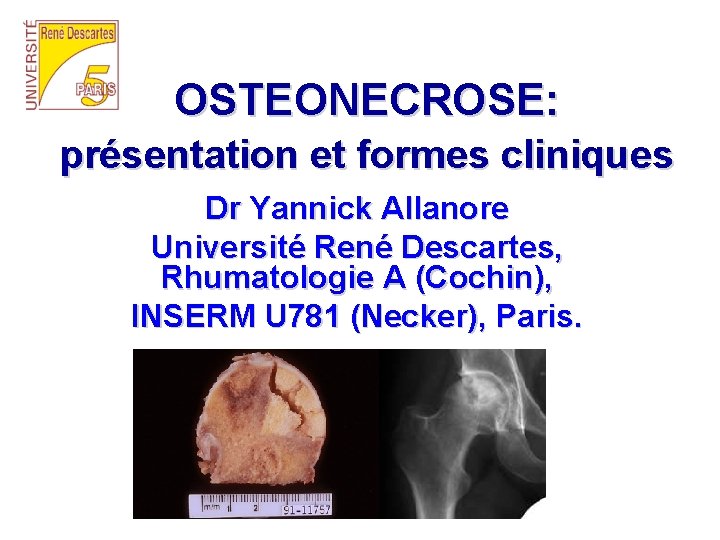 OSTEONECROSE: présentation et formes cliniques Dr Yannick Allanore Université René Descartes, Rhumatologie A (Cochin),
