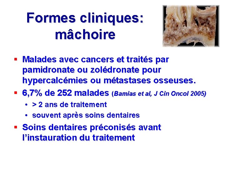 Formes cliniques: mâchoire § Malades avec cancers et traités par pamidronate ou zolédronate pour