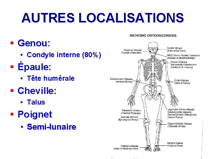 AUTRES LOCALISATIONS § Genou: • Condyle interne (80%) § Épaule: • Tête humérale §