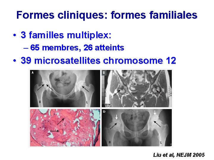 Formes cliniques: formes familiales • 3 familles multiplex: – 65 membres, 26 atteints •