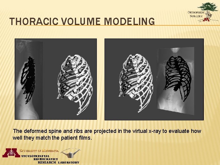 THORACIC VOLUME MODELING The deformed spine and ribs are projected in the virtual x-ray