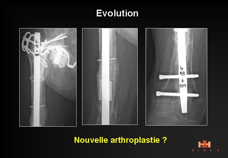 Evolution Nouvelle arthroplastie ? N I M E S 