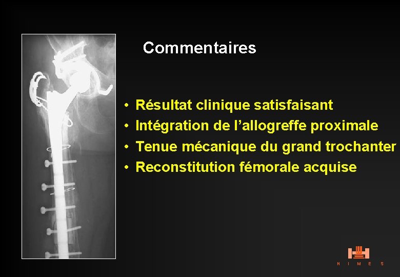 Commentaires • • Résultat clinique satisfaisant Intégration de l’allogreffe proximale Tenue mécanique du grand