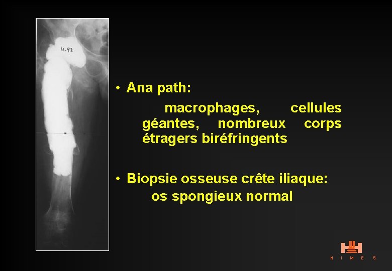  • Ana path: macrophages, cellules géantes, nombreux corps étragers biréfringents • Biopsie osseuse