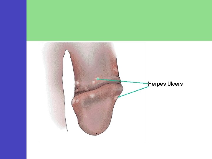 Herpes Ulcers 