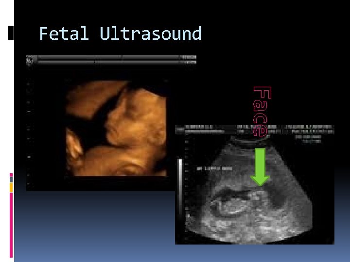 Fetal Ultrasound Face 