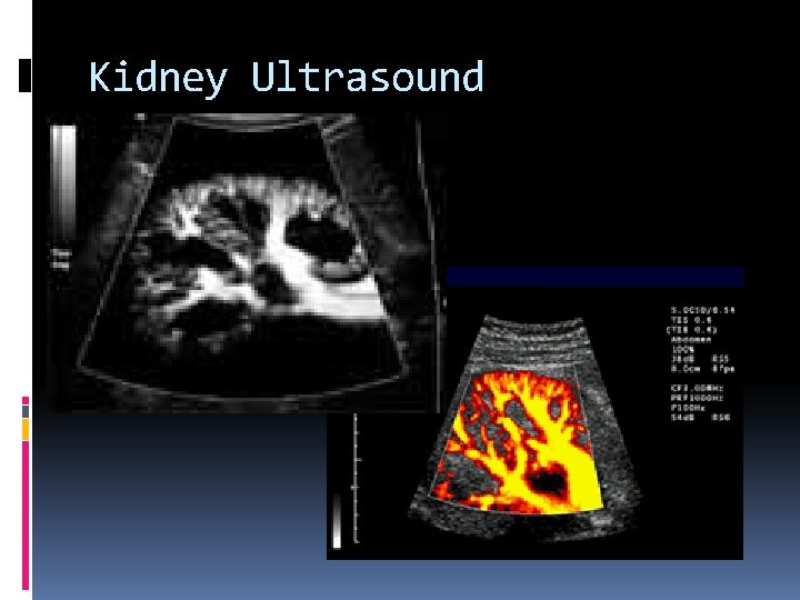 Kidney Ultrasound 