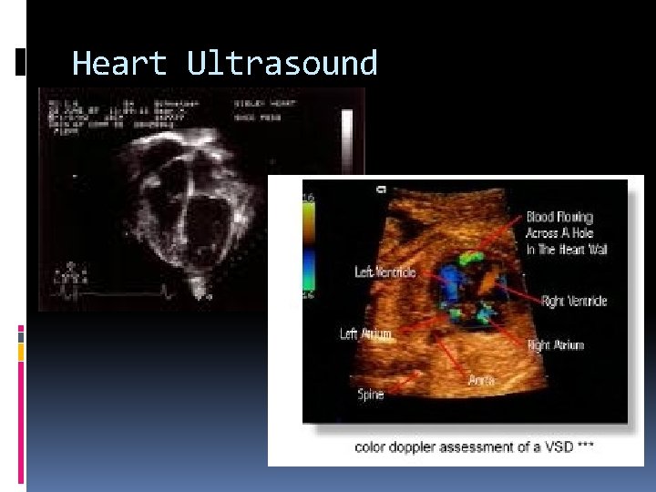 Heart Ultrasound 