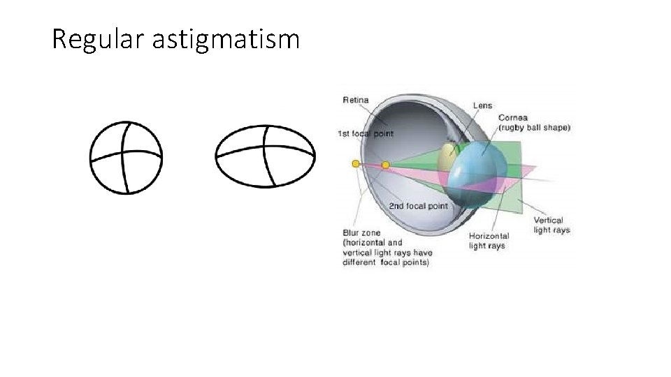 Regular astigmatism 