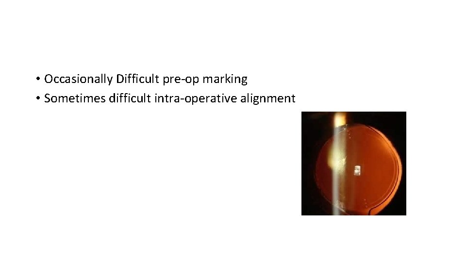  • Occasionally Difficult pre-op marking • Sometimes difficult intra-operative alignment 