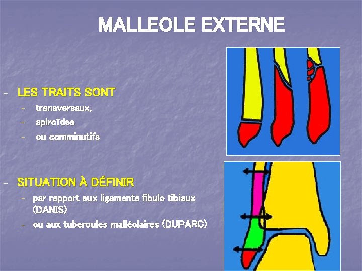 MALLEOLE EXTERNE - LES TRAITS SONT - - - transversaux, spiroïdes ou comminutifs SITUATION