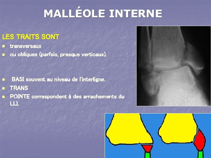 MALLÉOLE INTERNE LES TRAITS SONT n n n transversaux ou obliques (parfois, presque verticaux).