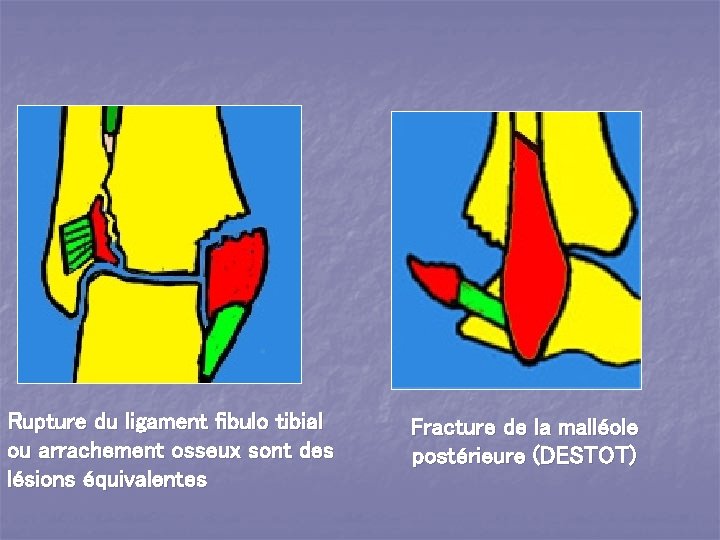 Rupture du ligament fibulo tibial ou arrachement osseux sont des lésions équivalentes Fracture de