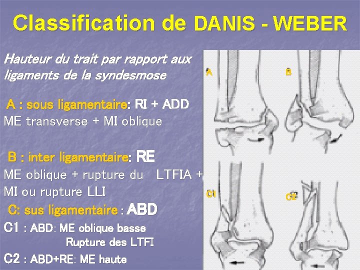 Classification de DANIS - WEBER Hauteur du trait par rapport aux ligaments de la