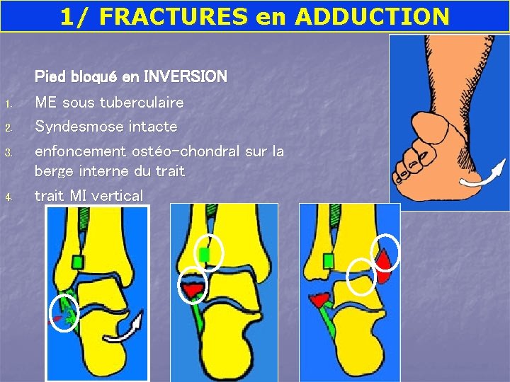 1/ FRACTURES en ADDUCTION 1. 2. 3. 4. Pied bloqué en INVERSION ME sous