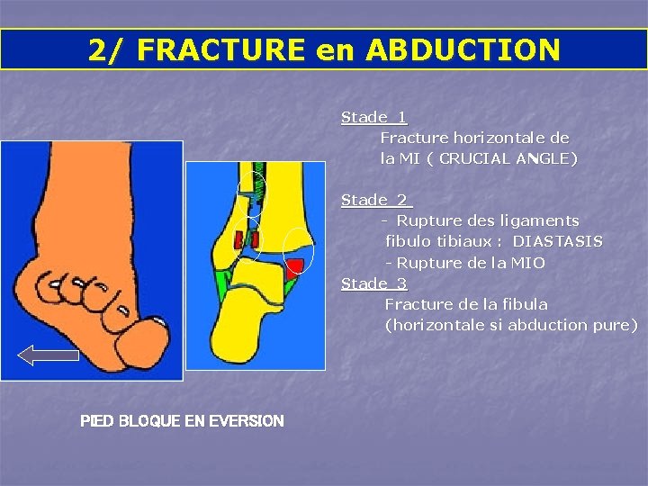 2/ FRACTURE en ABDUCTION Stade 1 Fracture horizontale de la MI ( CRUCIAL ANGLE)