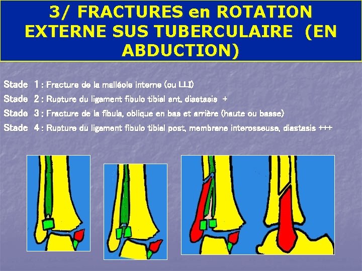 3/ FRACTURES en ROTATION EXTERNE SUS TUBERCULAIRE (EN ABDUCTION) Stade 1 : Fracture de