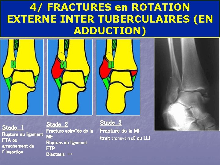 4/ FRACTURES en ROTATION EXTERNE INTER TUBERCULAIRES (EN ADDUCTION) Stade 1 Rupture du ligament