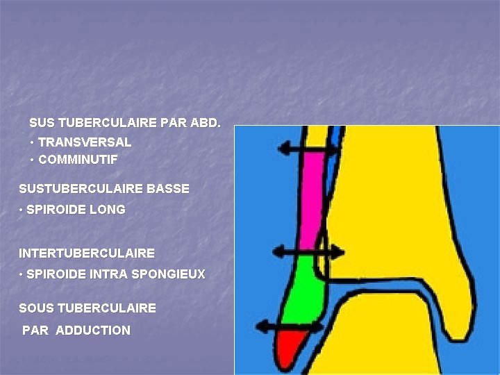 SUS TUBERCULAIRE PAR ABD. • TRANSVERSAL • COMMINUTIF SUSTUBERCULAIRE BASSE • SPIROIDE LONG INTERTUBERCULAIRE