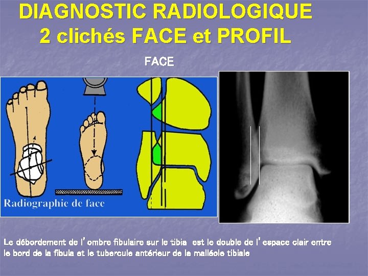 DIAGNOSTIC RADIOLOGIQUE 2 clichés FACE et PROFIL FACE Le débordement de l’ombre fibulaire sur