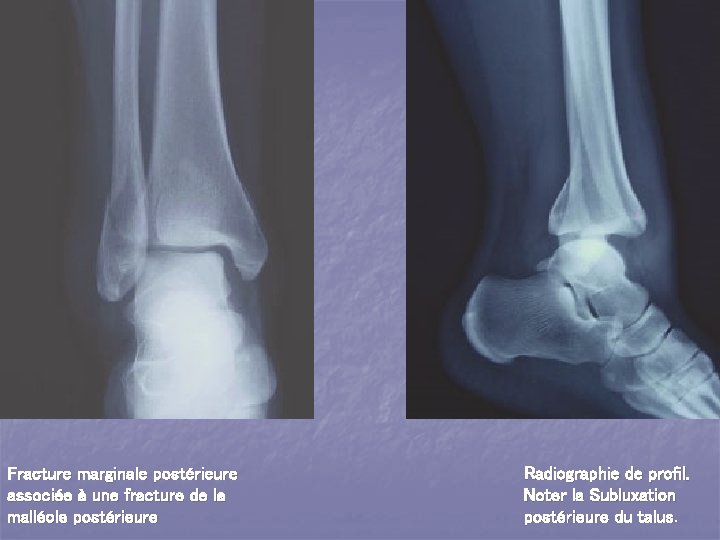 Fracture marginale postérieure associée à une fracture de la malléole postérieure Radiographie de profil.