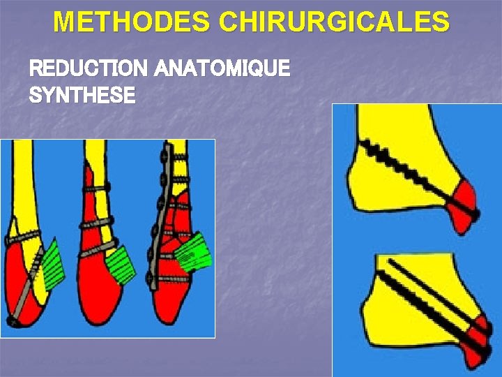METHODES CHIRURGICALES REDUCTION ANATOMIQUE SYNTHESE 