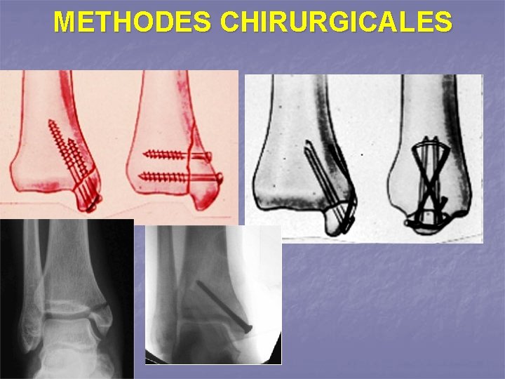 METHODES CHIRURGICALES 
