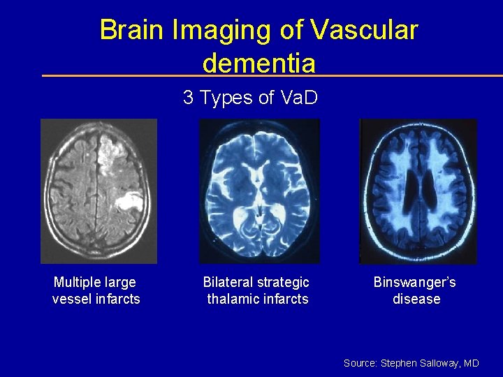 Brain Imaging of Vascular dementia 3 Types of Va. D Multiple large vessel infarcts