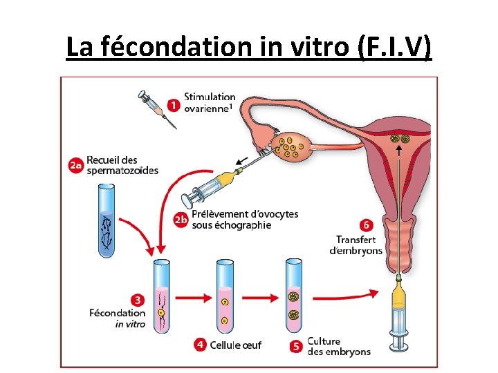 La fécondation in vitro (F. I. V) 
