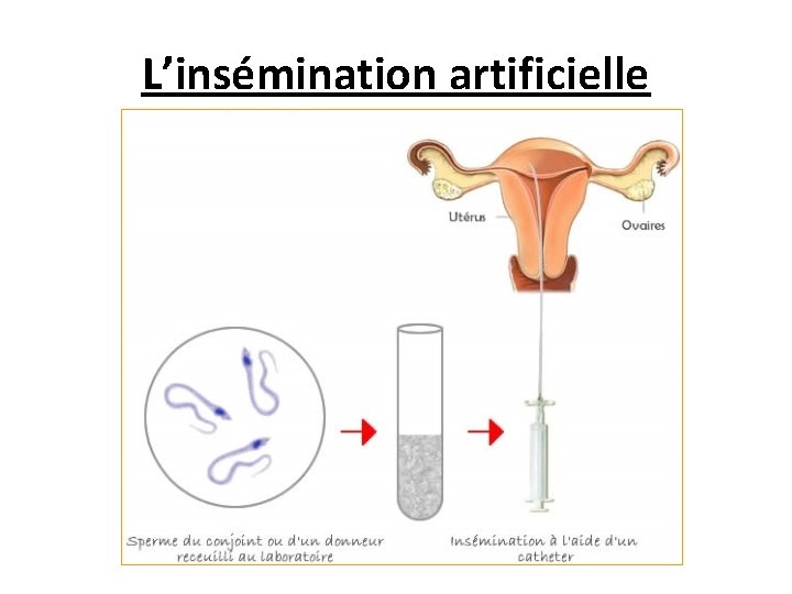 L’insémination artificielle 