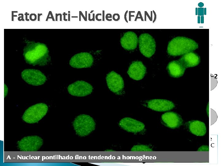 Fator Anti-Núcleo (FAN) Condições Clínicas Pacientes FAN + (%) FAN importante para LES Esclerose