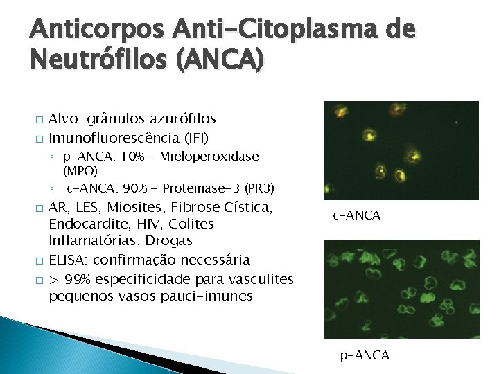 Anticorpos Anti-Citoplasma de Neutrófilos (ANCA) � � Alvo: grânulos azurófilos Imunofluorescência (IFI) ◦ p-ANCA: