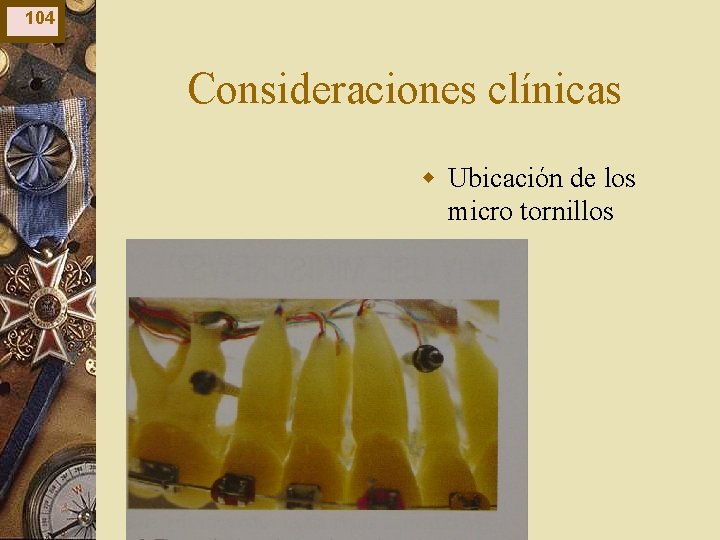 104 Consideraciones clínicas w Ubicación de los micro tornillos 104 Consideraciones clínicas w Ubicación de los micro tornillos