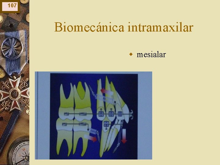 107 Biomecánica intramaxilar w mesialar 107 Biomecánica intramaxilar w mesialar