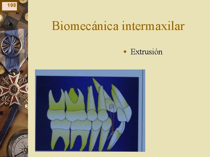 108 Biomecánica intermaxilar w Extrusión 108 Biomecánica intermaxilar w Extrusión