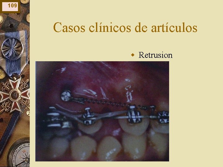 109 Casos clínicos de artículos w Retrusion 109 Casos clínicos de artículos w Retrusion