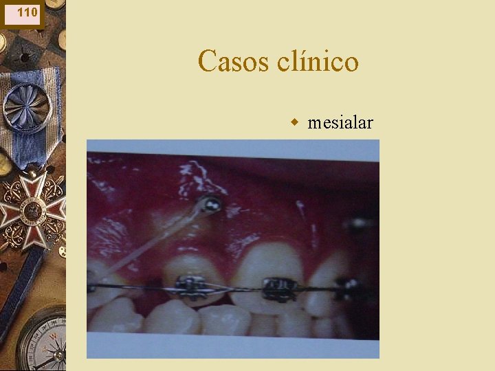 110 Casos clínico w mesialar 110 Casos clínico w mesialar