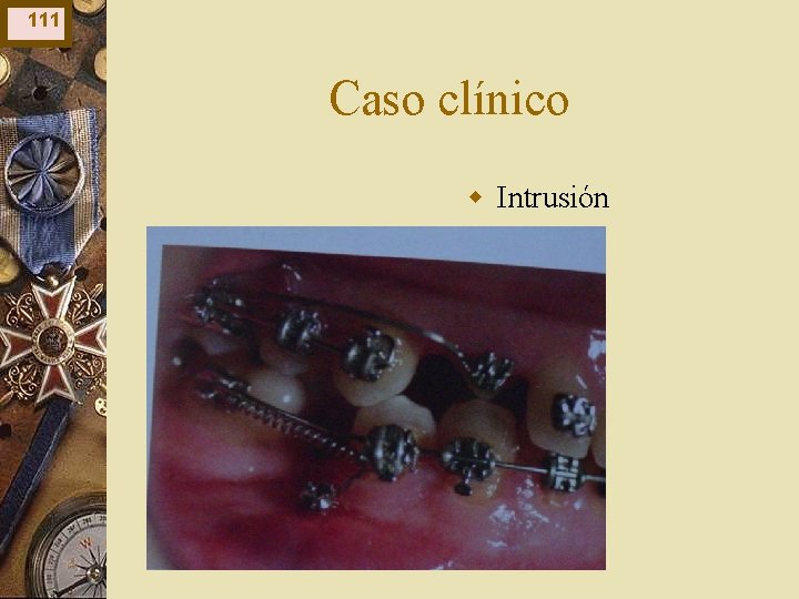 111 Caso clínico w Intrusión 111 Caso clínico w Intrusión